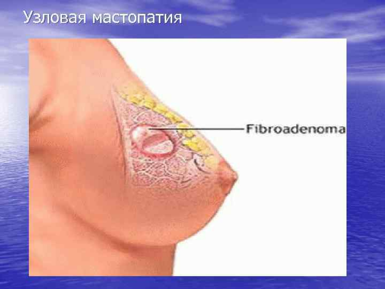Уплотнение в груди (уплотнение в молочных железах)