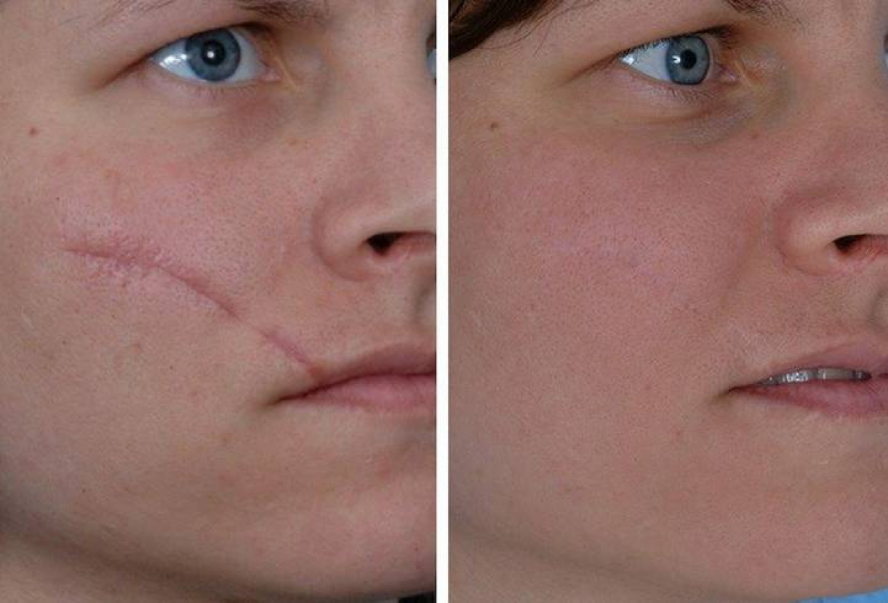 Удаление рубцов, шрамов, стрий на лице и теле