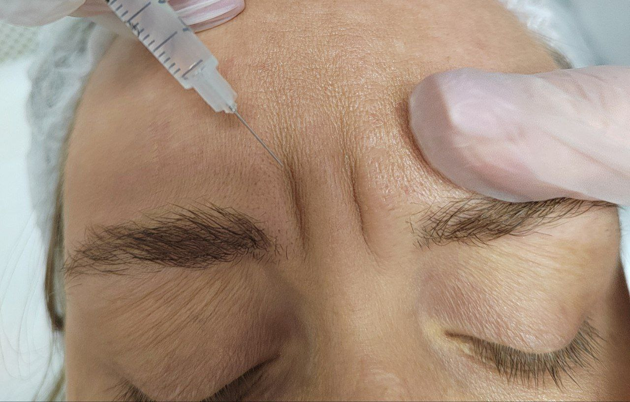 Коррекция мимических морщин Коррекция мимических морщин