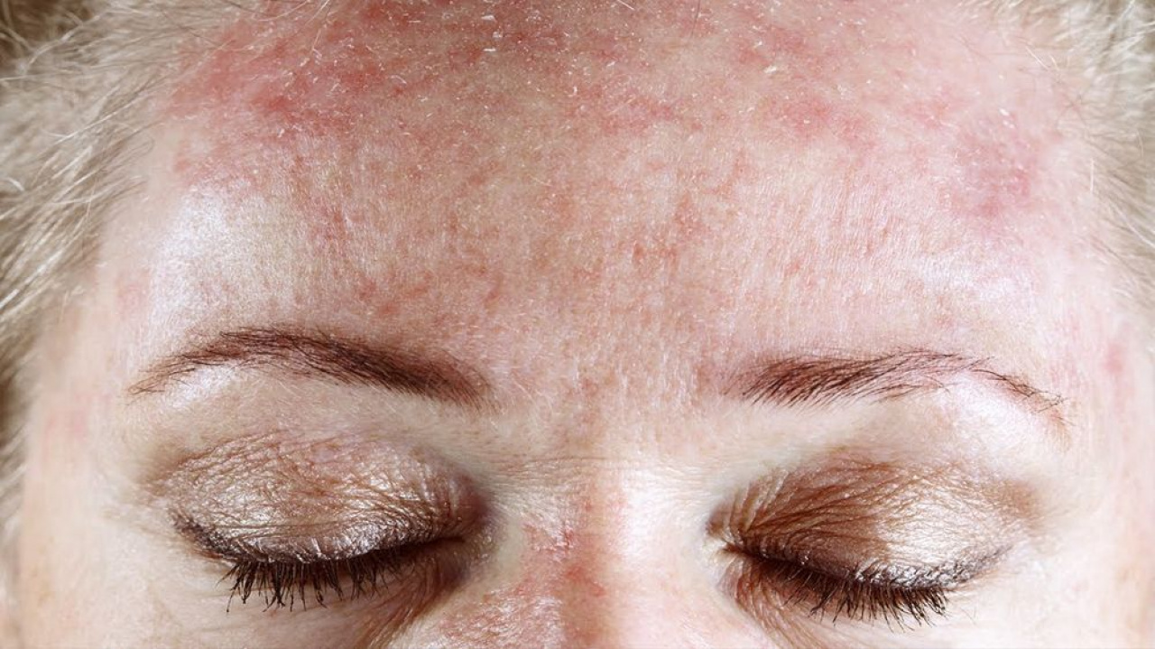 Дерматит кожи головы: симптомы и лечение - Клиника «Доктор Волос»