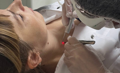 Удаление родинок, папиллом, бородавок, рубцов, шрамов, в т.ч. на половых органах